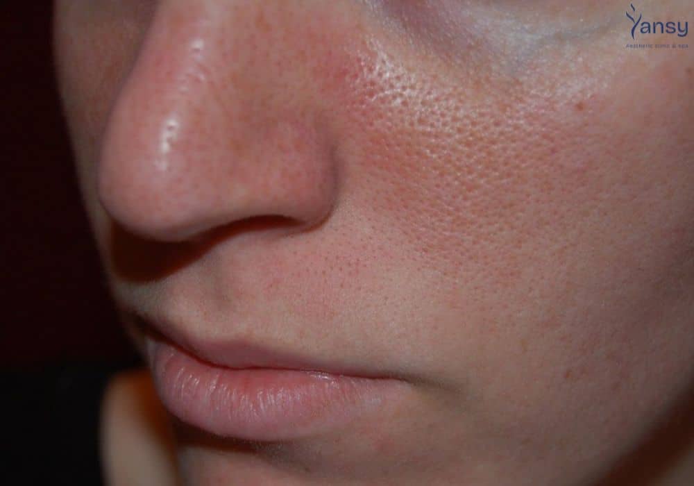 điều trị lỗ chân lông to hiệu quả