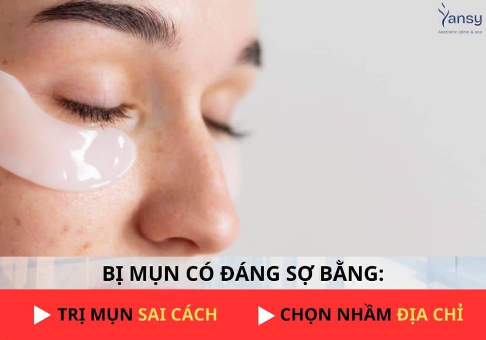 điều trị mụn tại spa