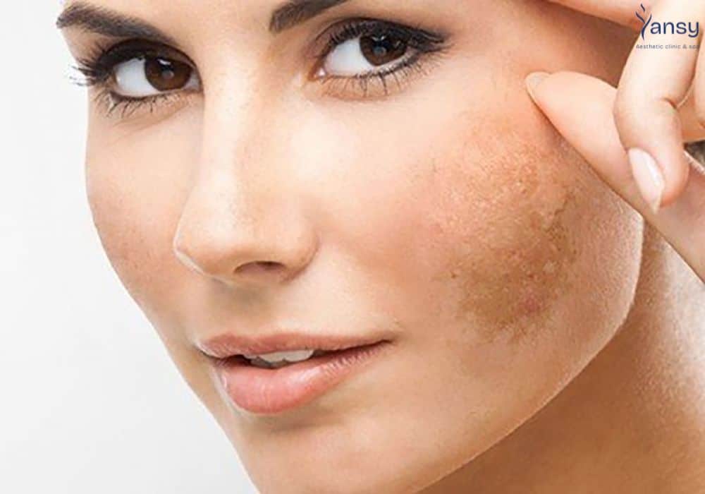 điều trị nám da