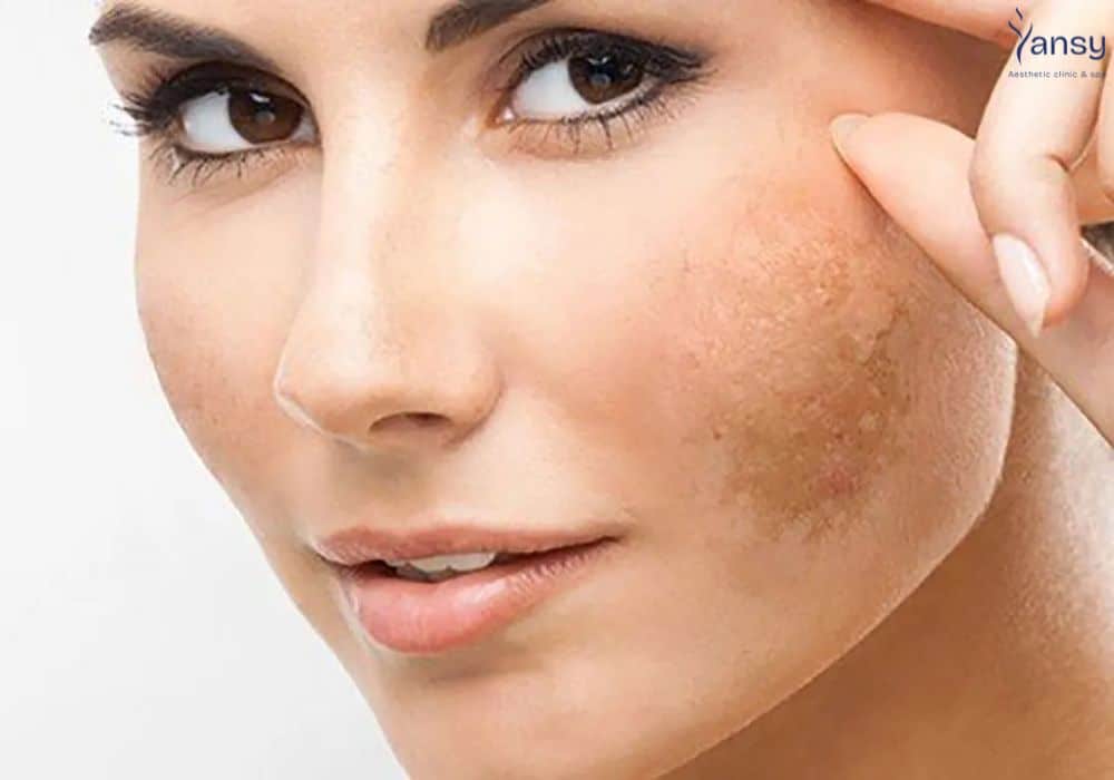 Da bị nám làm gì để hết? 7 cách trị nám da hiệu quả