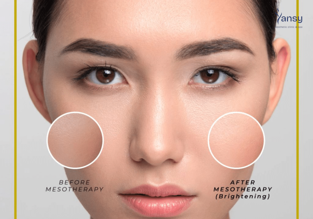 Meso Nano có hại không? Những ai nên sử dụng - Yansy Clinic
