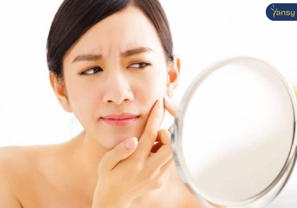 Các tình trạng mụn trên da thường gặp