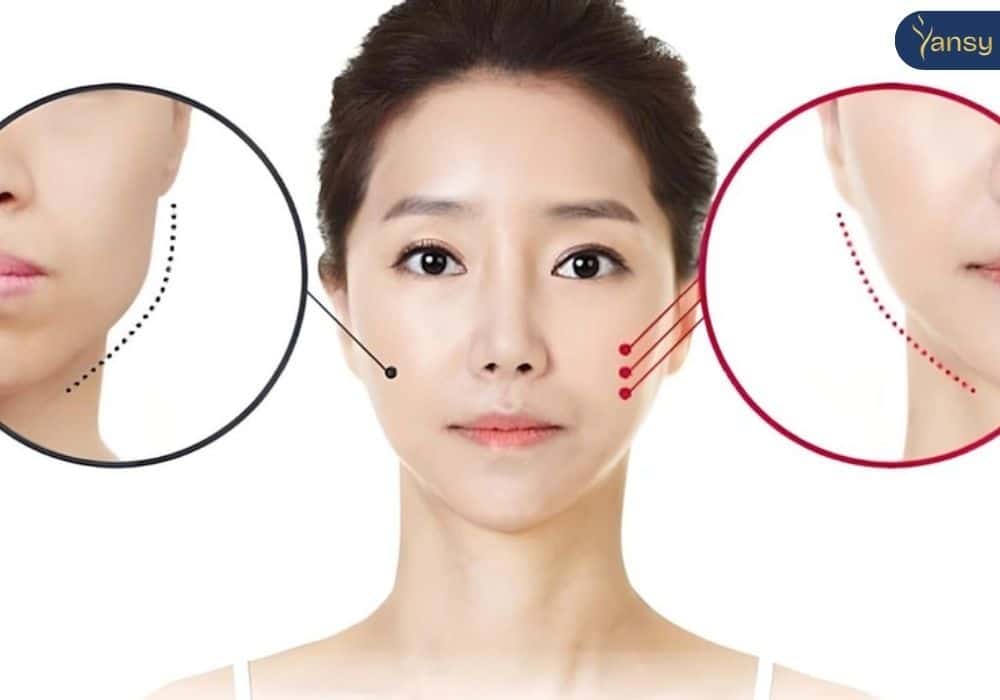 Những lưu ý sau khi làm thon gọn hàm