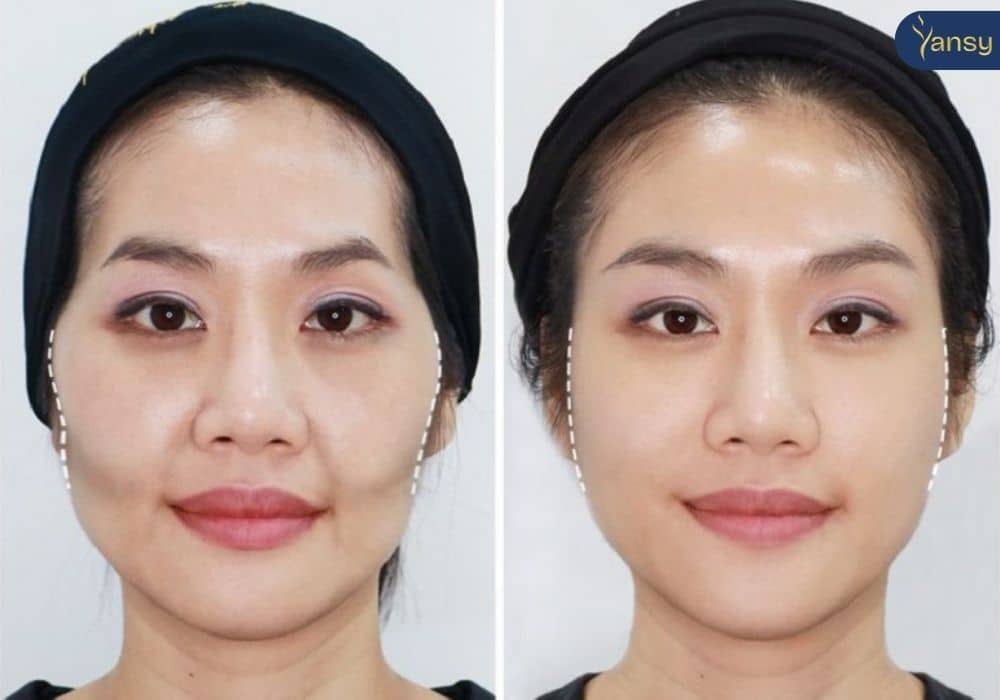 Lưu ý trước khi chọn Maxfill Pro