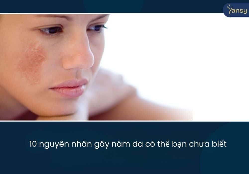 10 nguyên nhân gây nám da có thể bạn chưa biết
