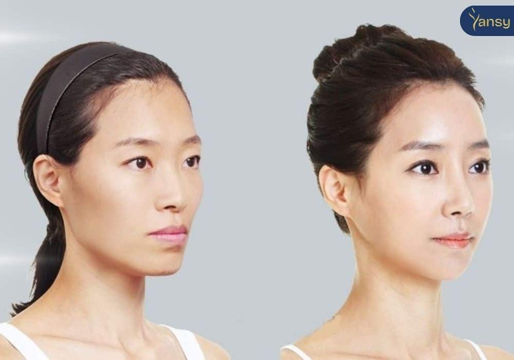 Thái dương hóp là gì? Có cải thiện được hay không?