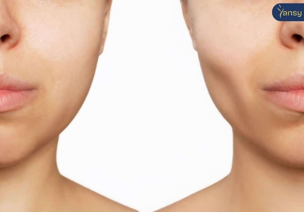 Những cách khắc phục má hóp hiệu quả nhất