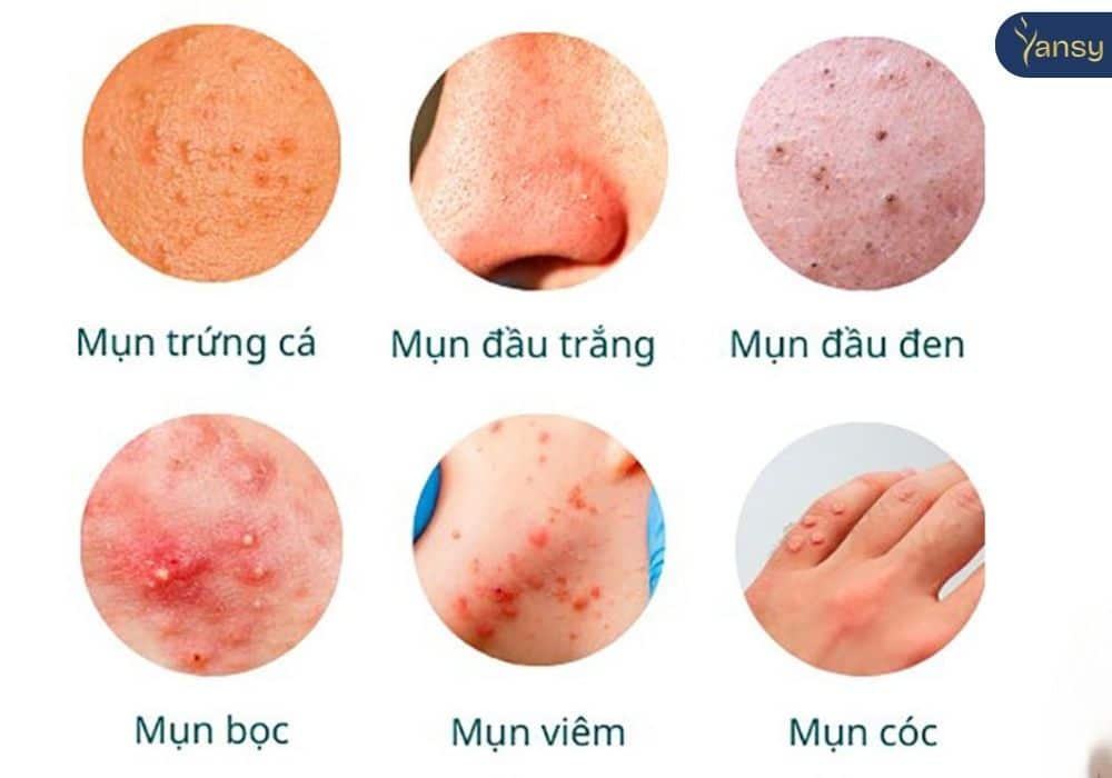 Nguyên nhân gây ra mụn ít ai ngờ đến