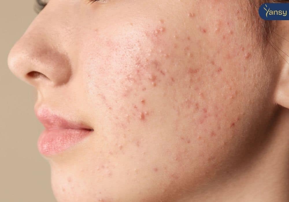 Top 5 spa trị mụn uy tín nhất tại Hà Nội