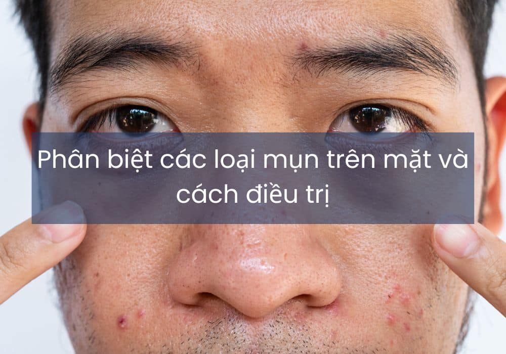 Phân biệt các loại mụn trên mặt và cách điều trị