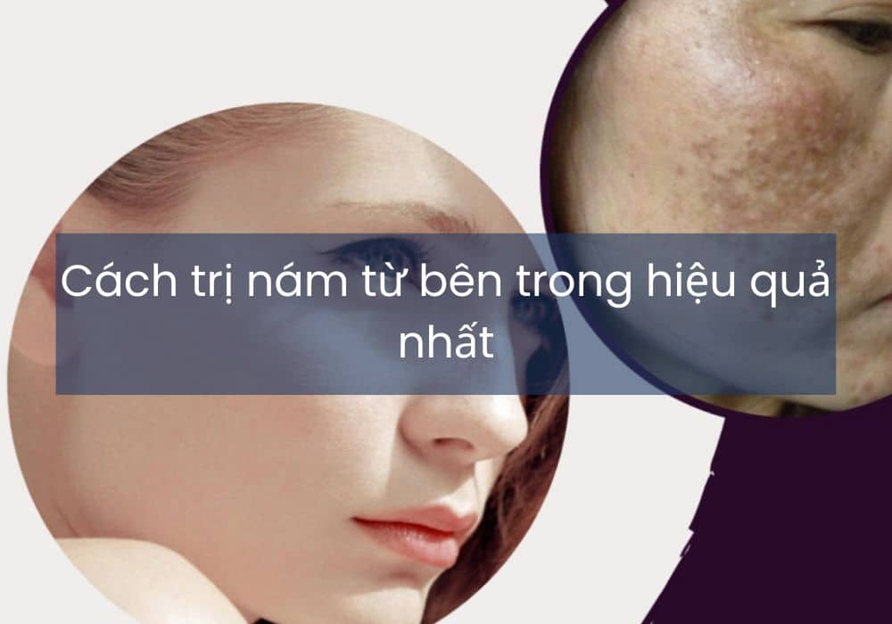 Cách trị nám từ bên trong hiệu quả nhất