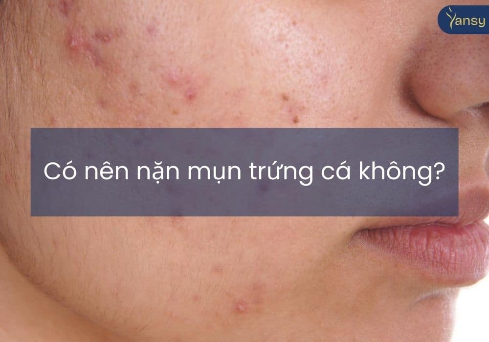 Có nên nặn mụn trứng cá không?