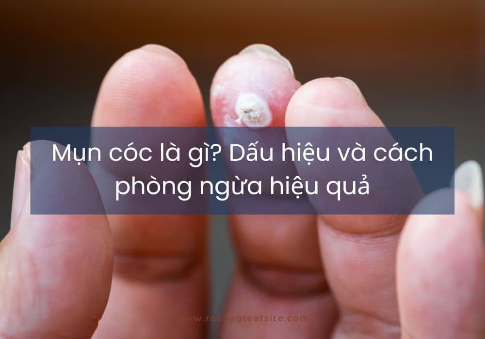 Mụn cóc là gì? Dấu hiệu và cách phòng ngừa hiệu quả
