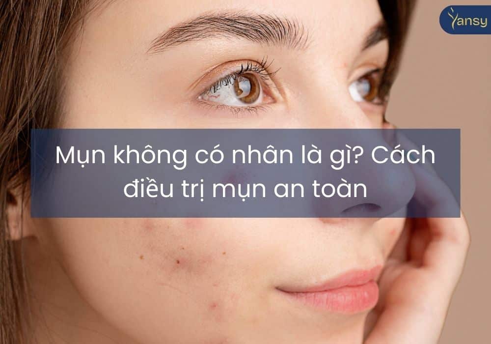 Mụn không có nhân là gì? Cách điều trị mụn an toàn