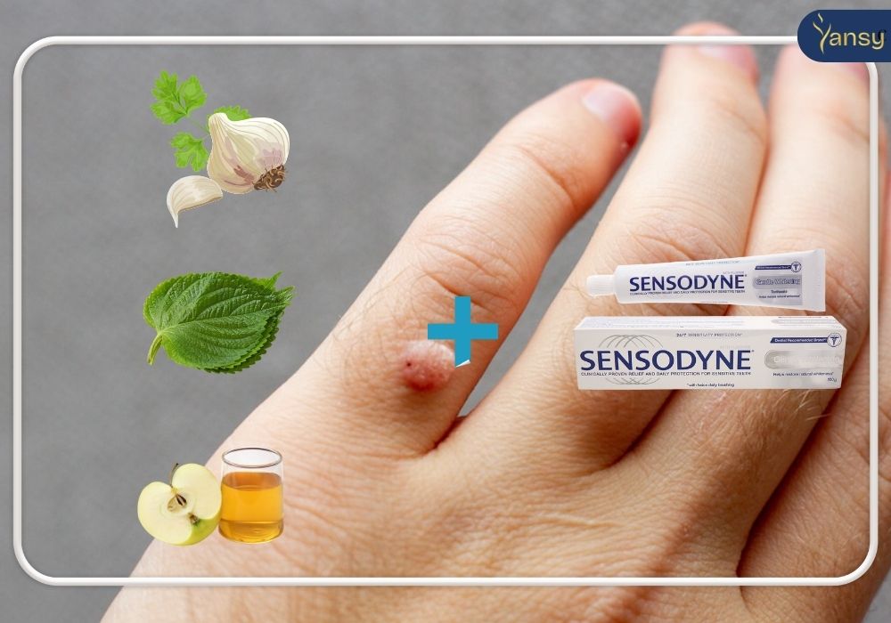 Trị mụn cóc bằng kem đánh răng có hiệu quả không?