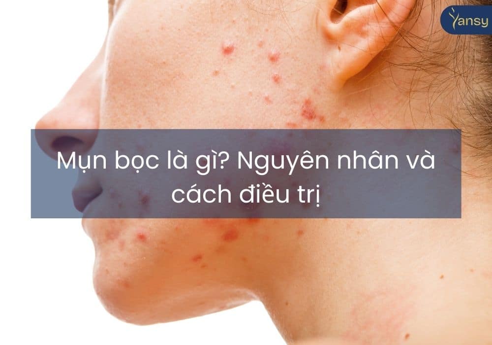 Mụn bọc là gì? Nguyên nhân và cách điều trị