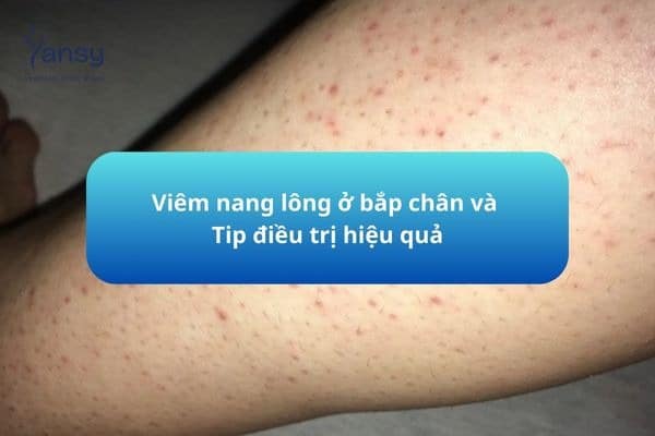 Viêm nang lông ở bắp chân