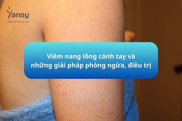 viêm nang lông cánh tay