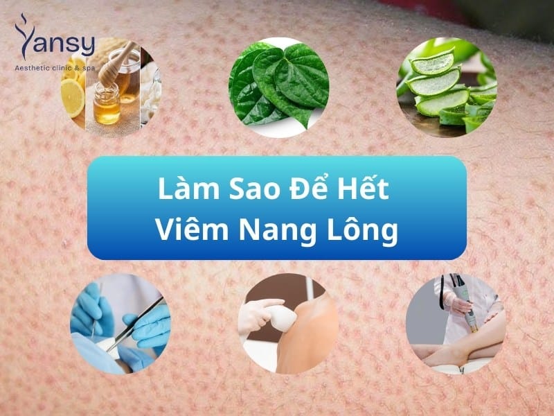 làm sao để hết viêm nang lông