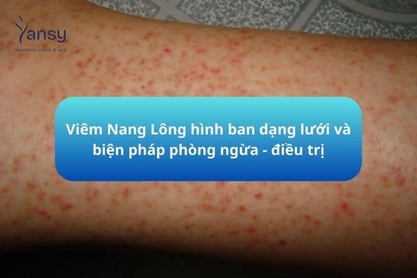 Viêm nang lông hồng ban mạng lưới