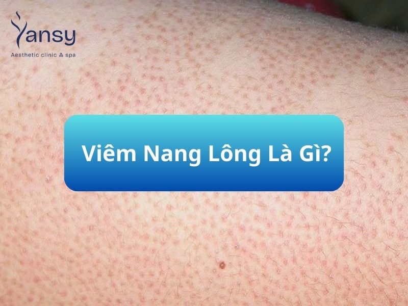 Viêm nang lông là gì?