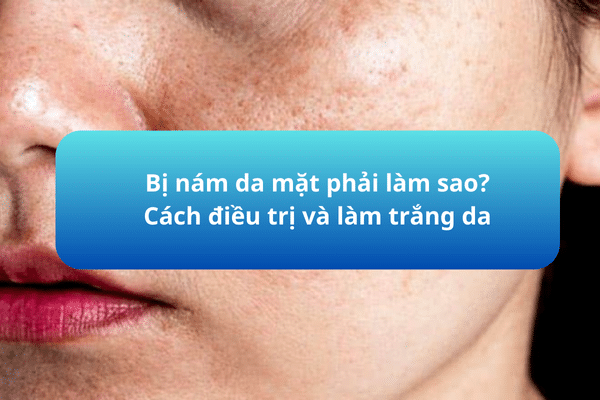 Bị nám da mặt phải làm sao