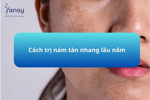 Cách trị nám tàn nhang lâu năm