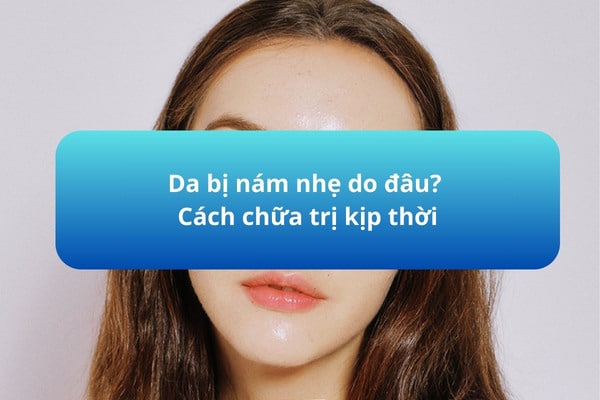Da bị nám nhẹ do đâu