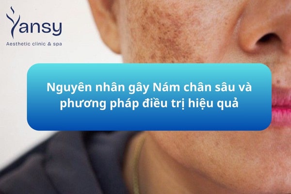 nguyên nhân gây nám chân sâu và cách điều trị