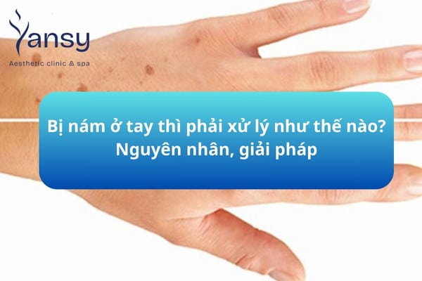 bị nám ở tay thì phải làm gì