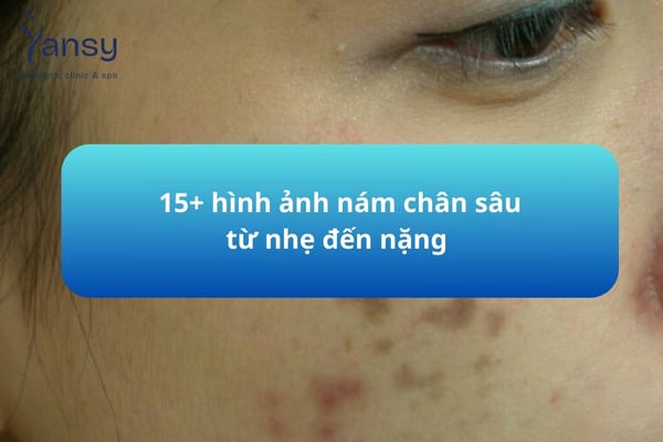 15 hình ảnh nám chân sâu