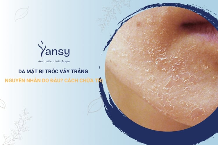 Da mặt bị tróc vảy trắng do đâu