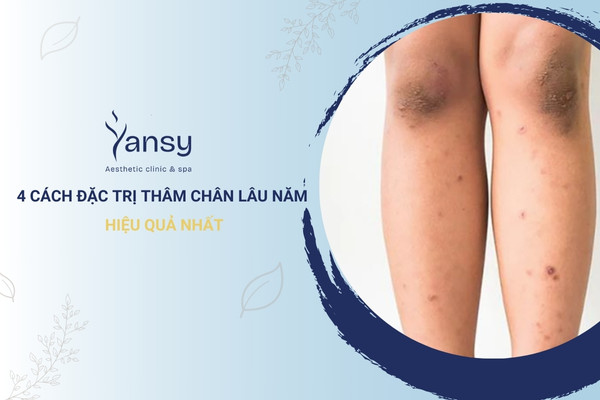 4 Cách đặc trị thâm chân lâu năm hiệu quả nhất