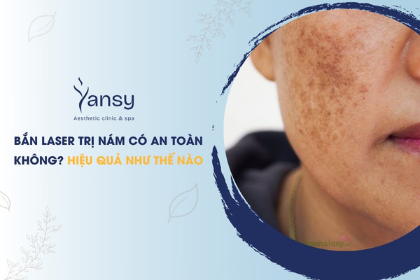bắn laser trị nám