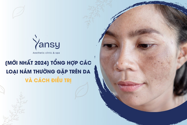 các loại nám