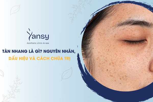 tàn nhang là gì