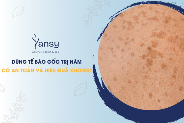 tế bào gốc trị nám