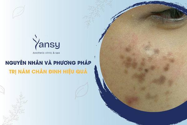 trị nám chân đinh