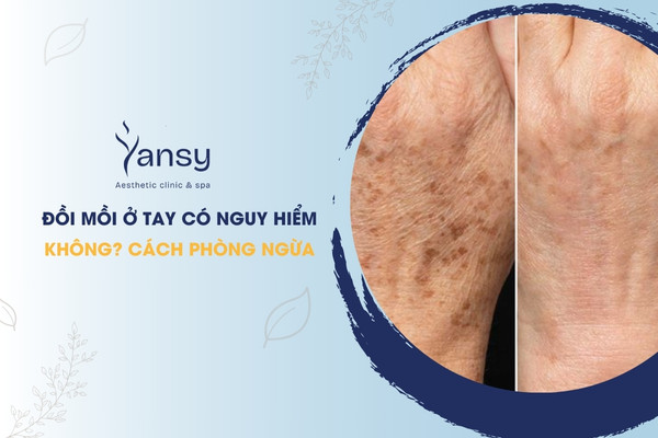 đồi mồi ở tay