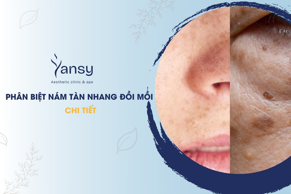 phân biệt nám tàn nhang đồi mồi
