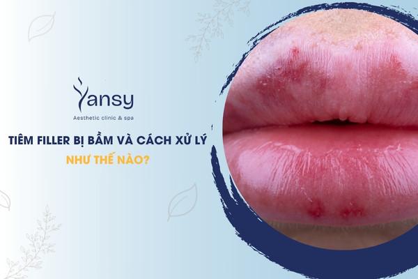 Tiêm filler bị bầm