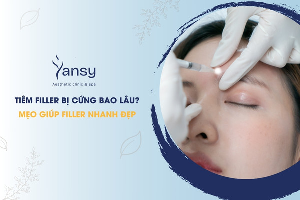 tiêm filler bị cứng bao lâu