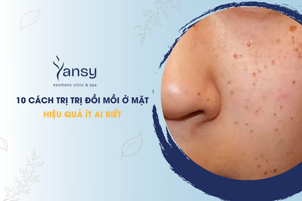 trị đồi mồi ở mặt