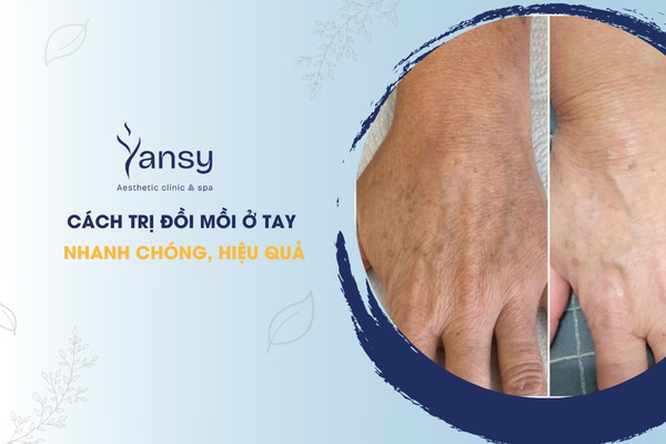 Trị đồi mồi ở tay