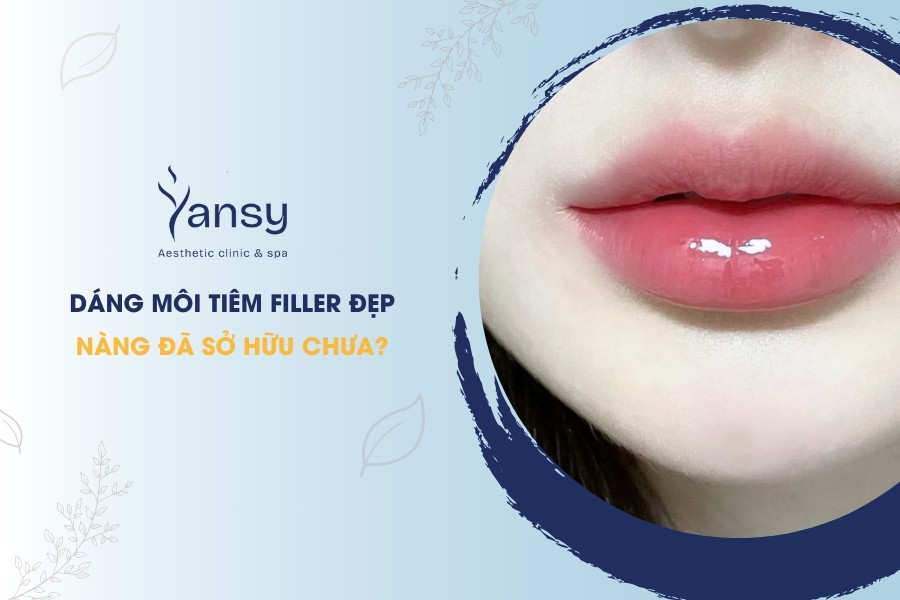 dáng môi tiêm filler đẹp