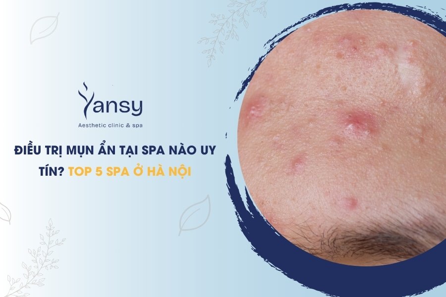điều trị mụn ẩn tại spa