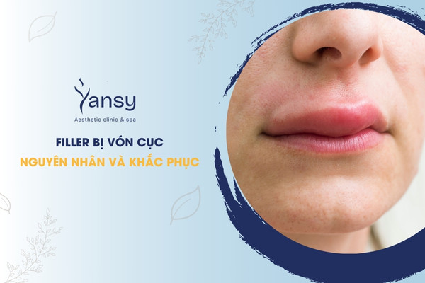filler bị vón cục