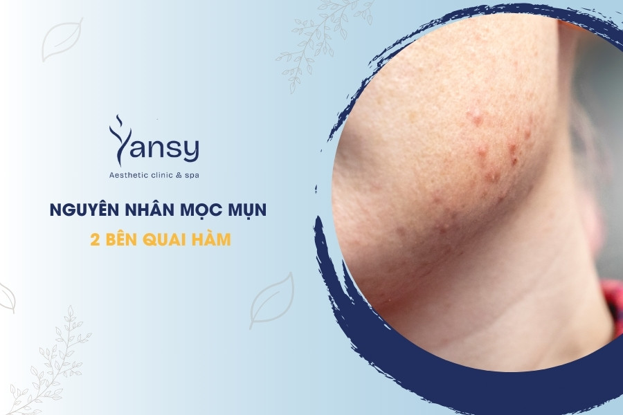 mụn 2 bên quai hàm