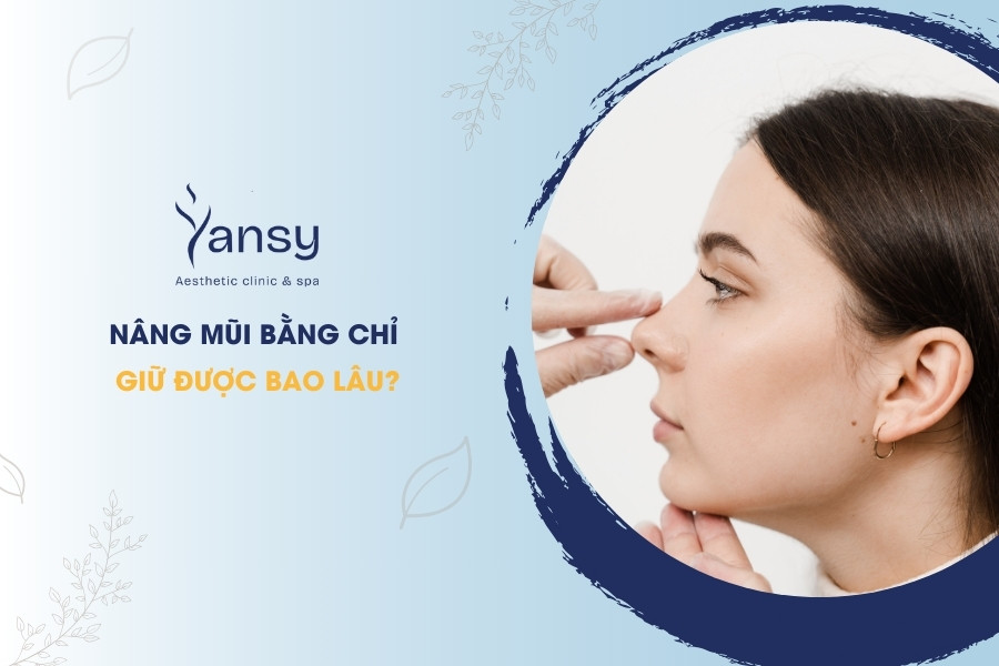 Nâng mũi bằng chỉ giữ được bao lâu