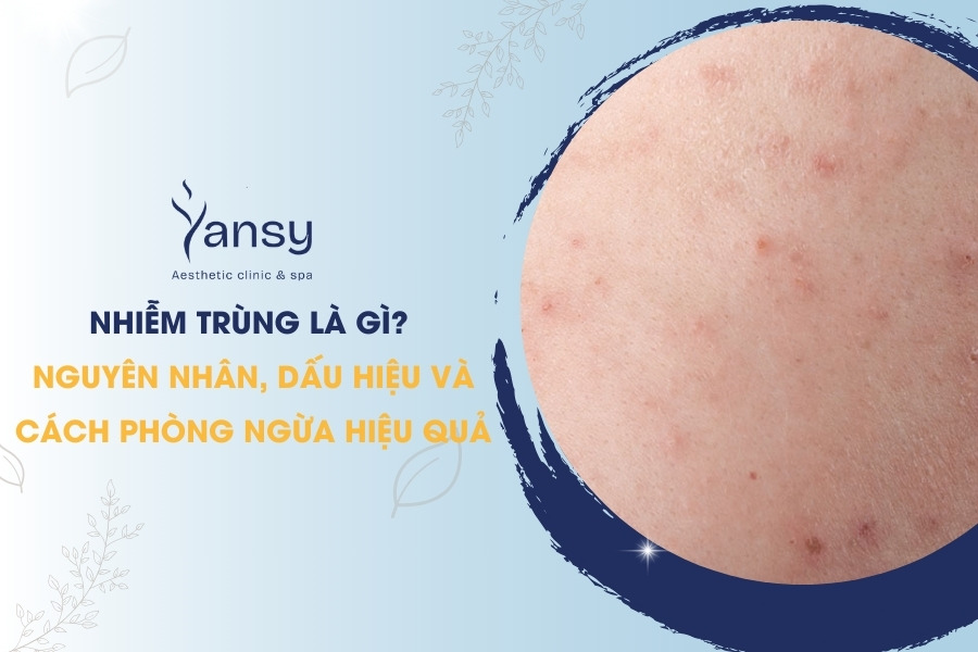 Nhiễm Trùng Là Gì? Nguyên Nhân, Dấu Hiệu và Cách Phòng Ngừa Hiệu Quả